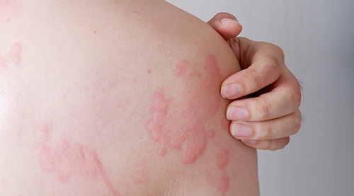 Close-up of skin with raised red welts and hives showing urticaria allergic reaction symptoms
