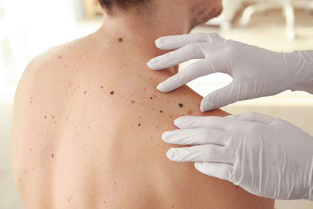 Dermatologist wearing gloves examining patient's mole on their back in medical clinic.