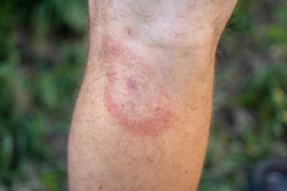 Red circular rash with bull's-eye pattern on human leg, characteristic of Lyme disease from tick bite